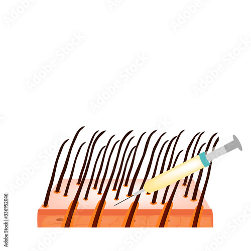 Treatment of alopecia. Bald spot, baldness, Alopecia mesotherapy. Infographics. Vector illustration on isolated background.