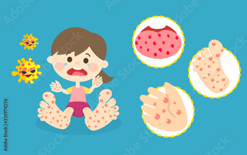 Hand Foot and Mouth Disease Vector photo