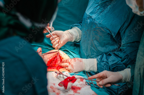 Stitching the abdominal tissues with stitches in hysterectomy surgery