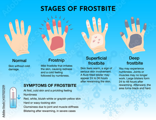 Medical frostbite stage and first aid infographic. Frozen hands with fingers. Vector illustration for web design.