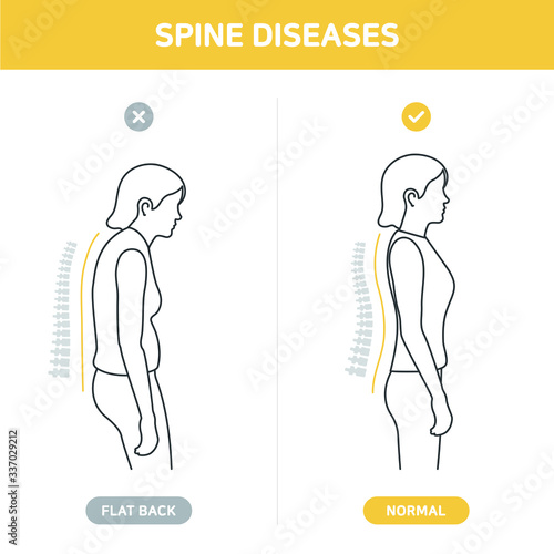 Woman standing in good and bad posture. Correct and incorrect pose. Scoliosis, Spine disease, Back body defect. Side view. Infographic, Icon, Flat design style. Isolated line vector illustration.