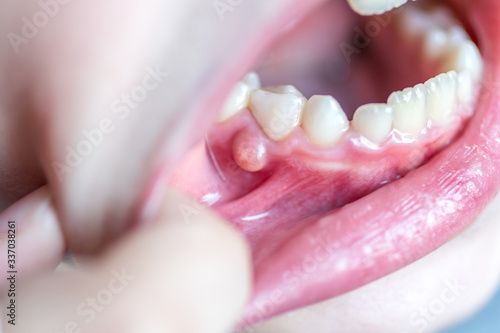 Close-up of a problem into kids mouth. Blister, pustule on the gums of a milk teeth of a small child.