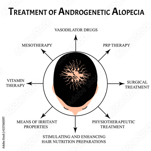 Treatment of alopecia. Bald spot, baldness, Alopecia mesotherapy. Infographics. Vector illustration on isolated background.