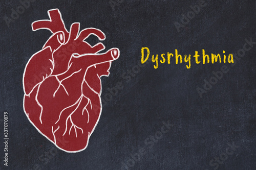 Chalk sketch of human heart on black desc and inscription Dysrhythmia photo