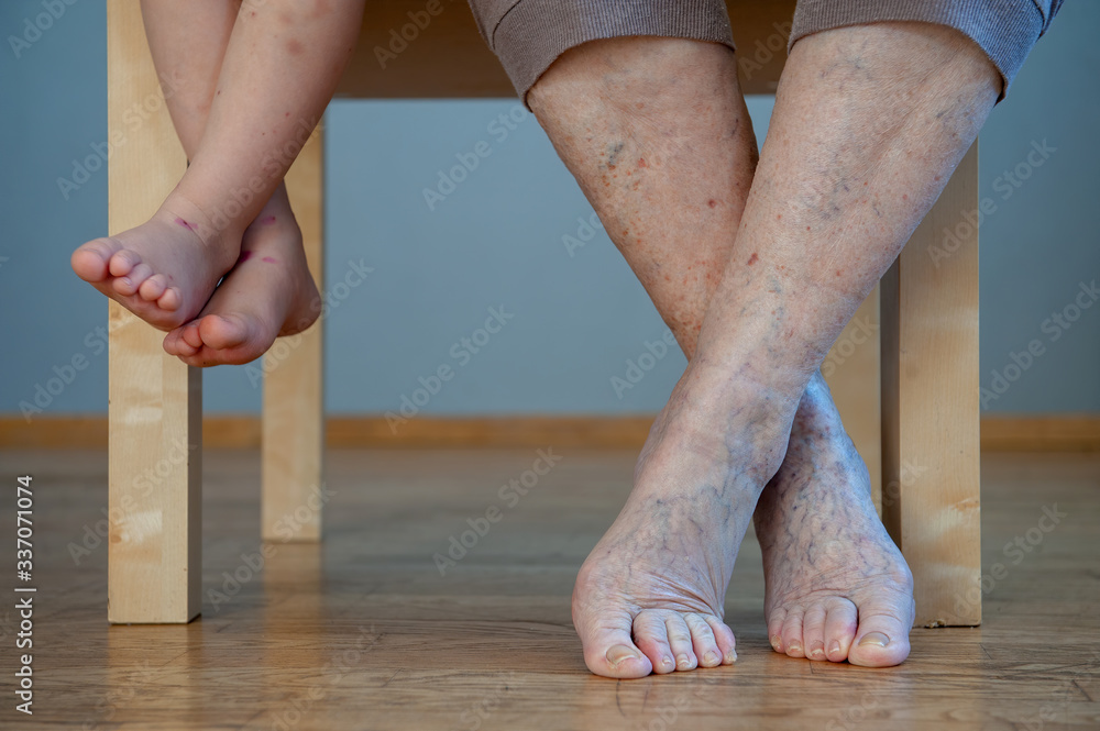 elderly woman with sore legs is sitting on chair and preparing for