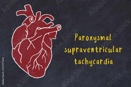 Concept of learning cardiovascular system. Chalk drawing of human heart and inscription Paroxysmal supraventricular tachycardia photo