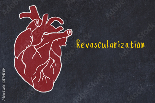 Concept of learning cardiovascular system. Chalk drawing of human heart and inscription Revascularization photo