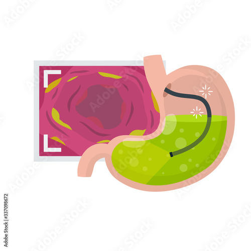Gastroscopy. Endoscopy and digestive problems. Hose with camera. Procedure with internal organs. Cartoon flat illustration. Medical Visual inspection of stomach. Scan of monitor with screen