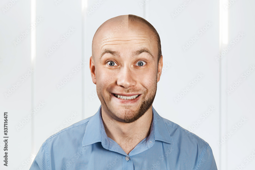 Fototapeta premium Portrait Man before and after hair loss, transplant. Split personality.