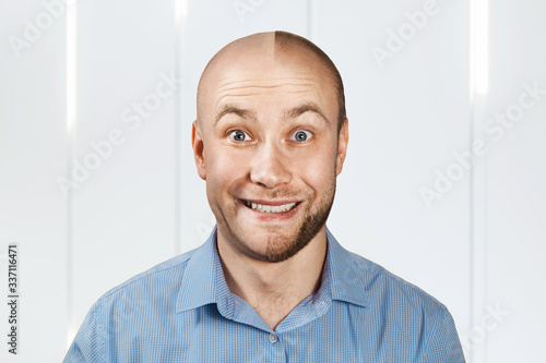 Portrait Man before and after hair loss, transplant. Split personality.