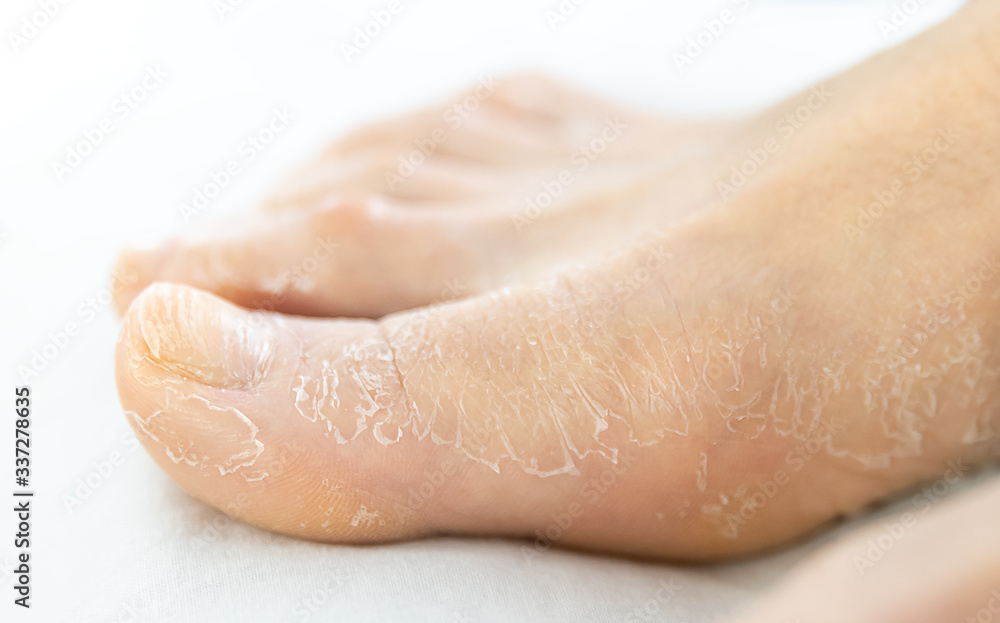 Fototapeta premium female foot with cracked dry skin, close-up on a white background