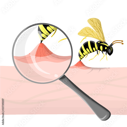 Wasp sting human. Close up detailed with magnifier pathogenesis of bee stings and allergic reaction. Vector illustration in cartoon relistic style. Medical poster, anaphylaxis, summer danger. insect. photo