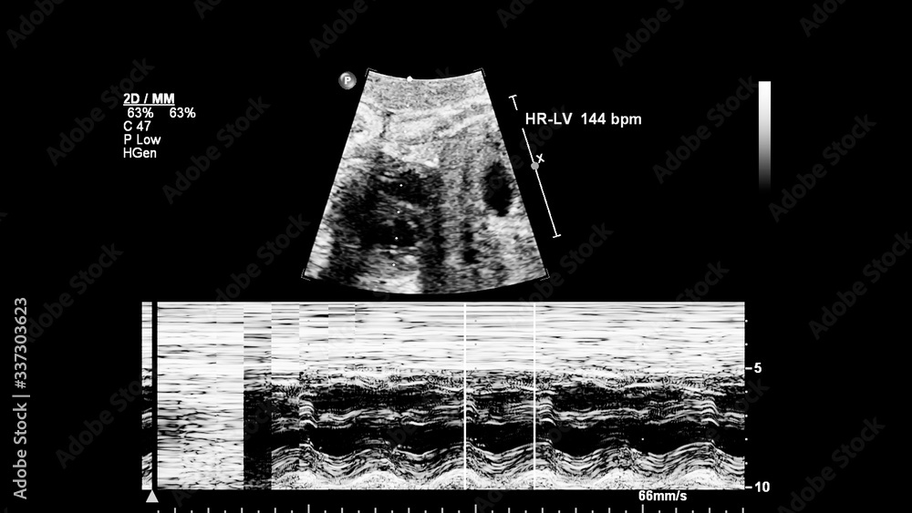 Fototapeta premium Ultrasound screen with fetal echocardiography