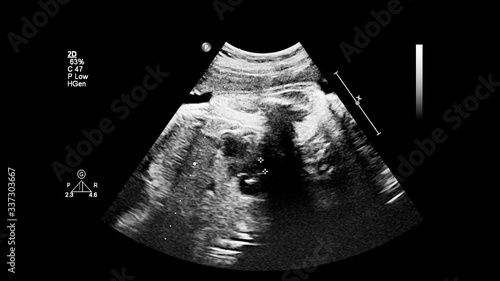 Ultrasound screen with fetal echocardiography