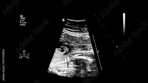 Ultrasound screen with fetal echocardiography