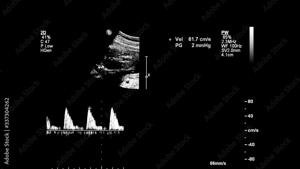 Obraz premium Ultrasound screen with fetal echocardiography