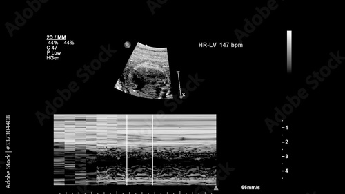 Ultrasound screen with fetal echocardiography