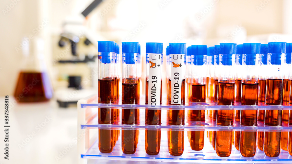 A lab doctor marking the test tube with positive for coronavirus A lab doctor marking the test tube with positive for coronavirus