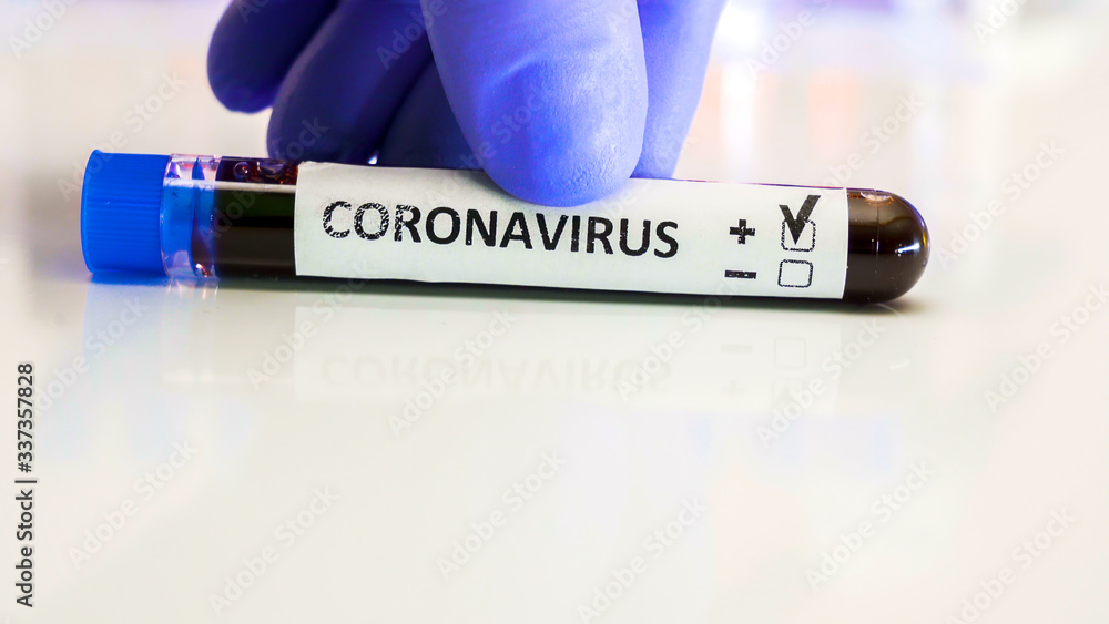 Fototapeta premium A test tube kit positive of COVID-19 coronavirus pandemic