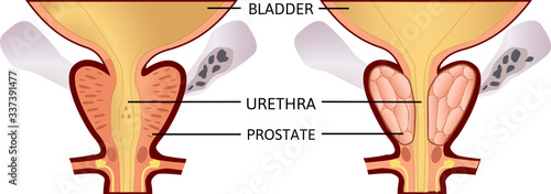 benign prostatic hyperplasia. prostatitis. vector illustration. Anatomy and health.