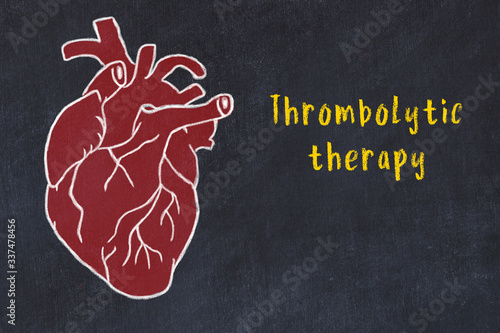 Chalk sketch of human heart on black desc and inscription Thrombolytic therapy photo