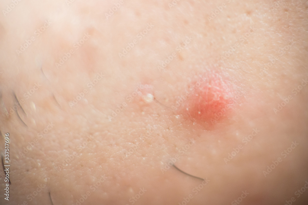 Red pimple on face macro, abscess and acne.