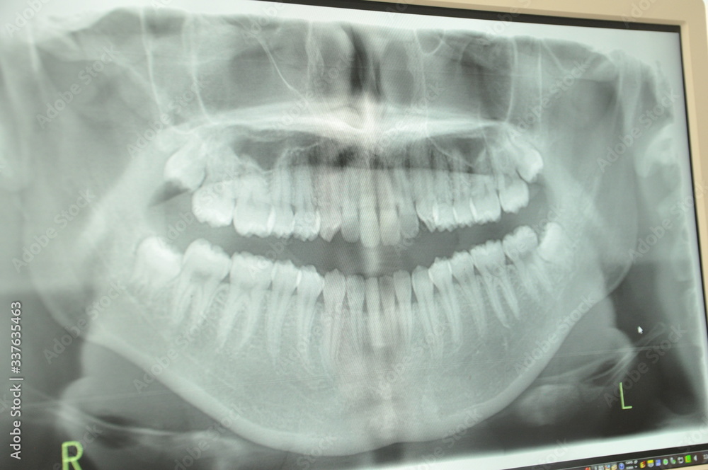 chest x ray chest x ray