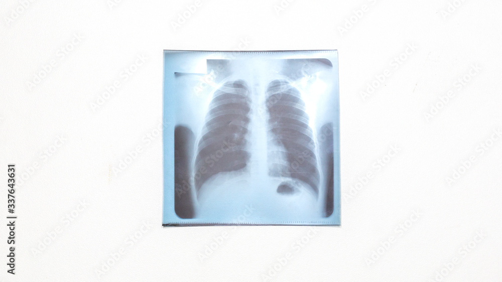 Fototapeta premium Lung x-ray film on white background