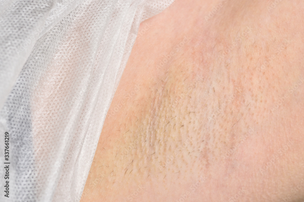 Fototapeta premium Female armpit with hair before depilation. Beauty and skin care concept.