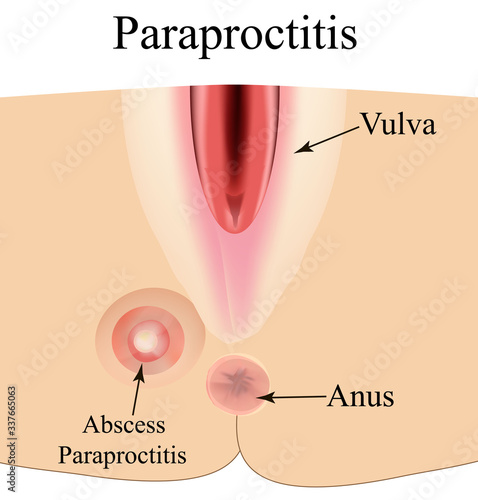 Paraproctitis. Abscess in the perineum. Inflammation paraproctitis. Infographics. Vector illustration on isolated background.