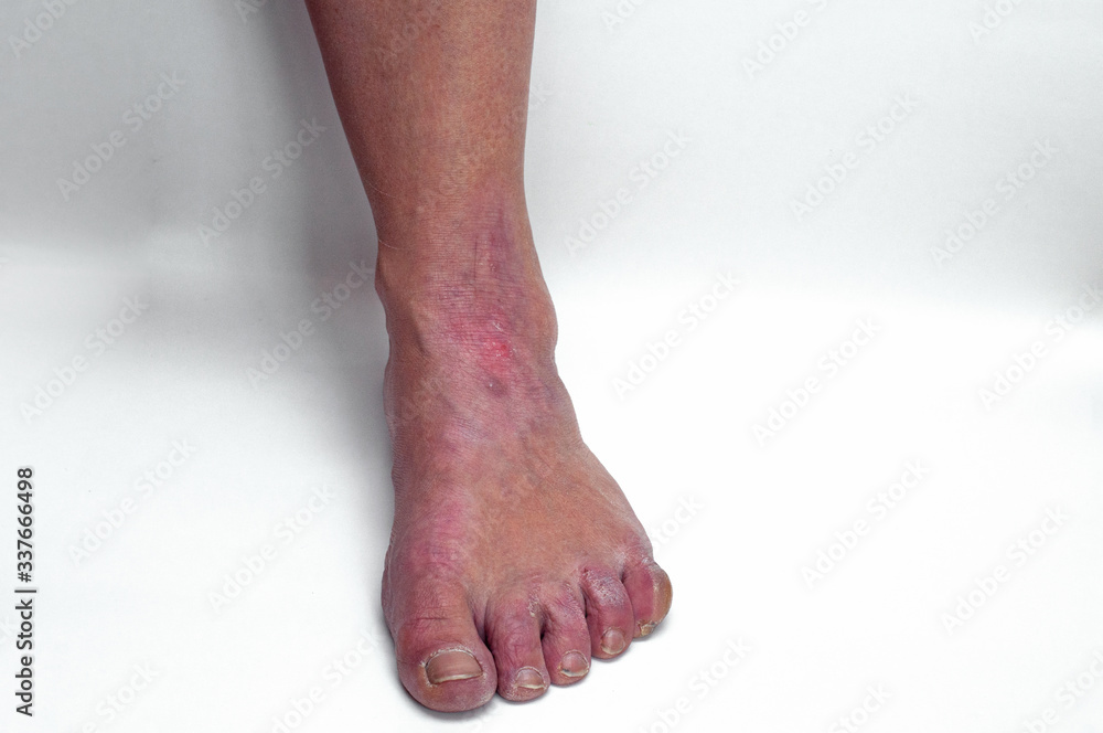 Close up of legs man suffering from chronic psoriasis on a white background Close up of legs man suffering from chronic psoriasis on a white background