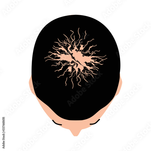 Alopecia hair. Baldness of hair on the head. Androgenic alopecia. Infographics. Vector illustration on isolated background.