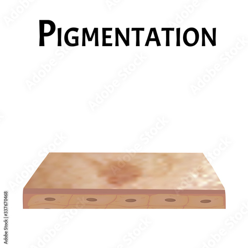 Pigmentation on the skin. Brown spots on the skin. Pigmentation treatment. Infographics. Vector illustration on isolated background.