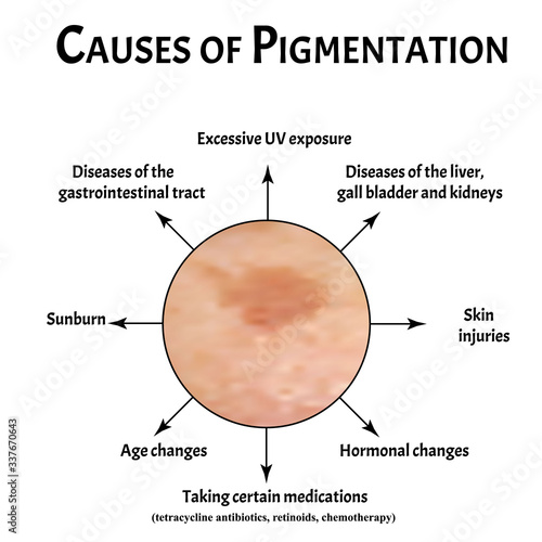 Pigmentation on the skin causes. Brown spots on the skin. Pigmentation treatment. Infographics. Vector illustration on isolated background.