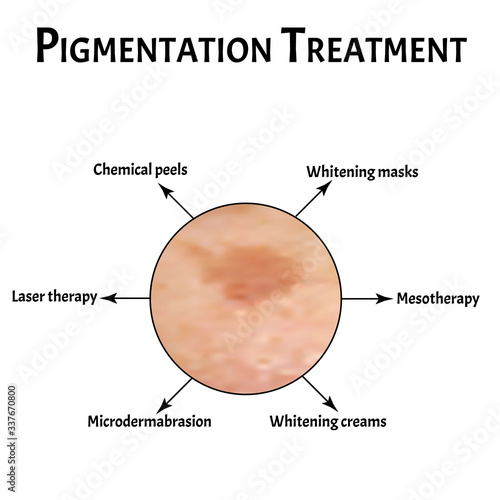 Pigmentation on the skin. Brown spots on the skin. Pigmentation treatment. Infographics. Vector illustration on isolated background.