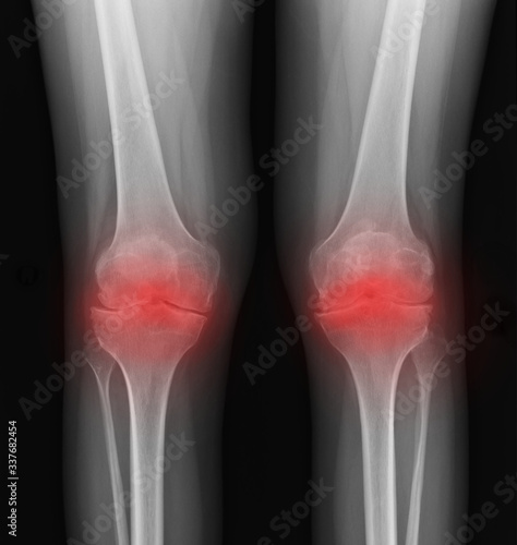 Real skeleton x-ray of woman knee suffering from rheumatism. Rheumatoid arthritis knee pain medical concept  medical diagnostics  traumatology and orthopedics