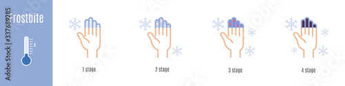 Stages of hand and fingers frostbite. Hypothermia. Medical infographic. Vector illustration