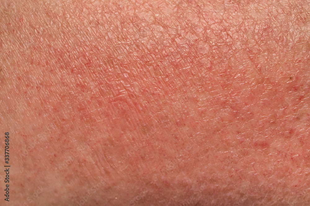 Skin manifestations of an allergic reaction to the sun close up. Soft focus, shallow depth of field. Skin manifestations of an allergic reaction to the sun close up. Soft focus, shallow depth of field.