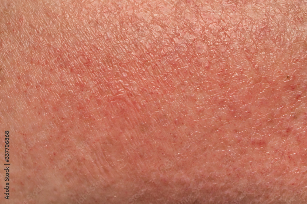 Skin manifestations of an allergic reaction to the sun close up. Soft focus, shallow depth of field.