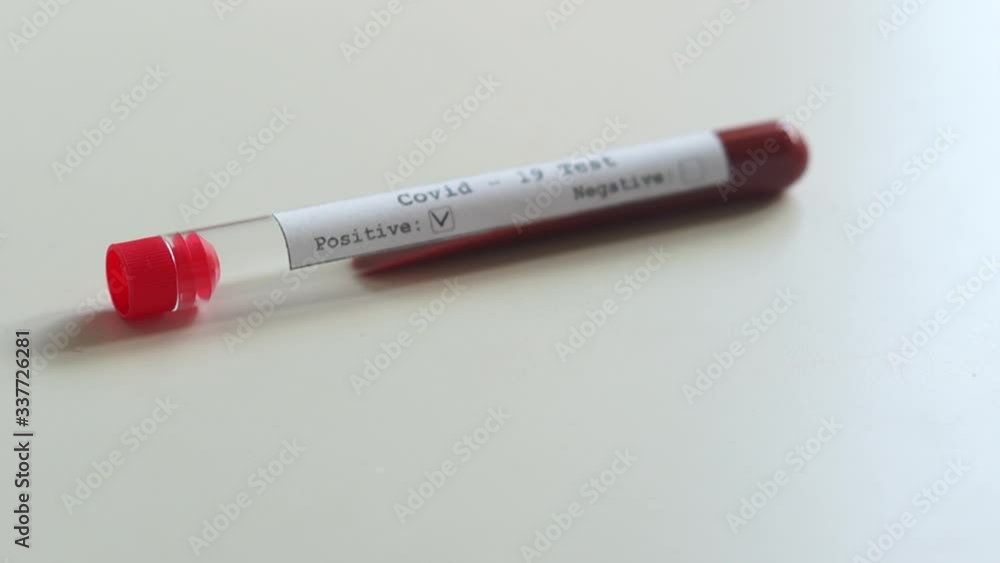 Close-up of a test tube with a blood plasma sample, positive test for coronovirus covid-19. Mass testing of the population for coronovirus, laboratory tests Close-up of a test tube with a blood plasma sample, positive test for coronovirus covid-19. Mass testing of the population for coronovirus, laboratory tests