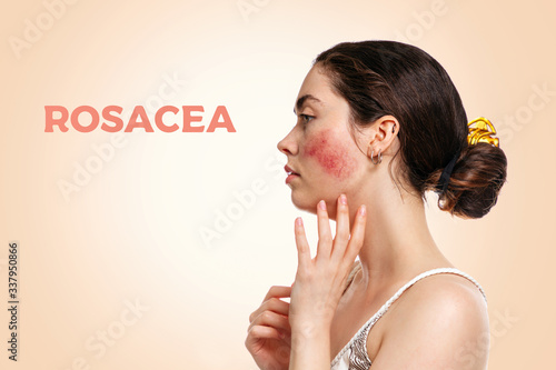 Portrait of a young beautiful Caucasian woman with reddened and inflamed blood vessels on her cheeks.Beige background.Side view.The inscription ROSACEA.The concept of rosacea, couperose and healthcare