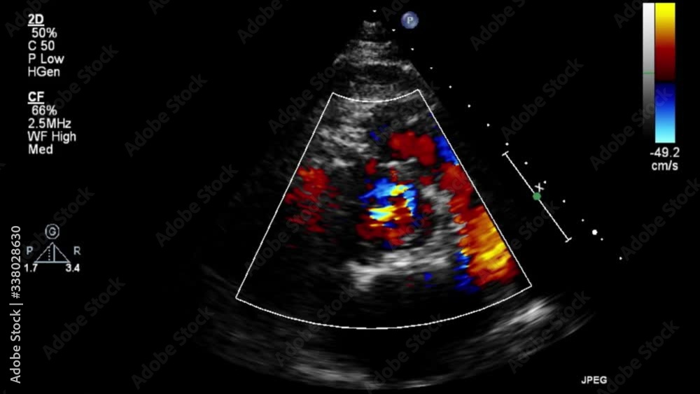 Transesophageal ultrasound video in Doppler mode. Transesophageal ultrasound video in Doppler mode.
