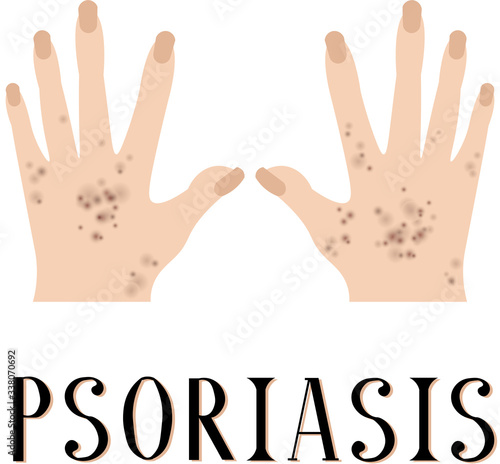 Psoriasis. Diseased skin. Sore hands. Medical poster. Dermatology and venereology.