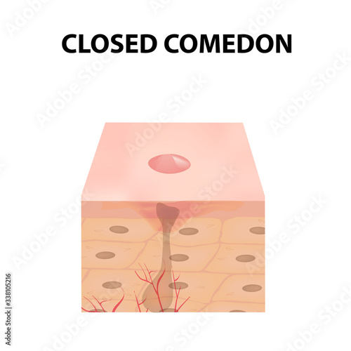Closed comedones. Acne on the skin. Dermatological and cosmetic diseases on the skin of the face acne. Infographics. Vector illustration on isolated background.