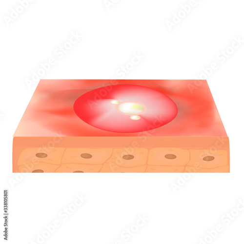 Cyst acne. furuncle Acne on the skin cysts and pimples. Dermatological and cosmetic inflammatory diseases on the skin of the face. Infographics. Vector illustration on isolated background.