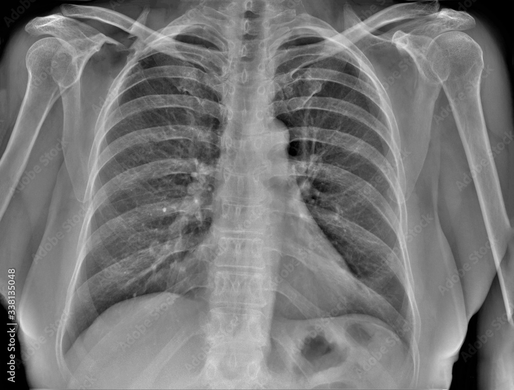 normal chest x-ray, diagnosis of pneumonia normal chest x-ray, diagnosis of pneumonia