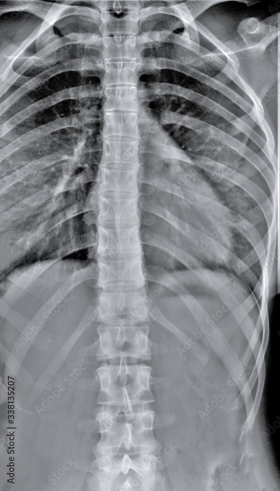 normal chest xray, diagnosis of pneumonia Stock Photo Adobe Stock