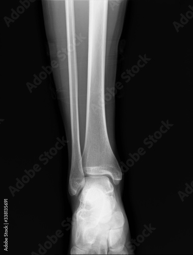 x-ray of the ankle joint  diagnosis of fractures