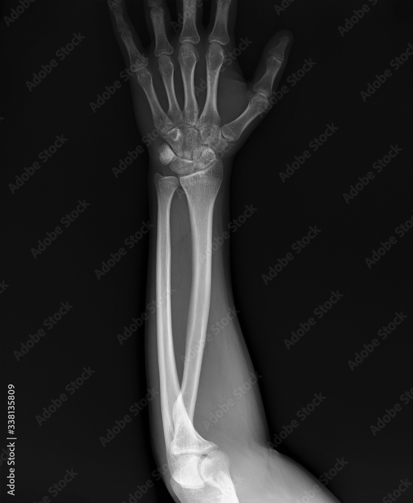 x-ray of the bones of the hand and wrist joint x-ray of the bones of the hand and wrist joint
