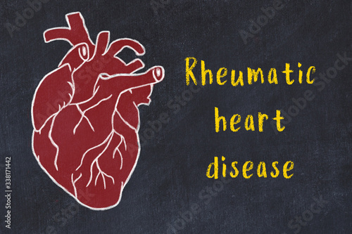 Chalk sketch of human heart on black desc and inscription Rheumatic heart disease
